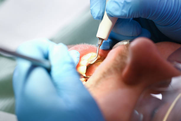Best Emergency Root Canal Treatment in Perryton, TX