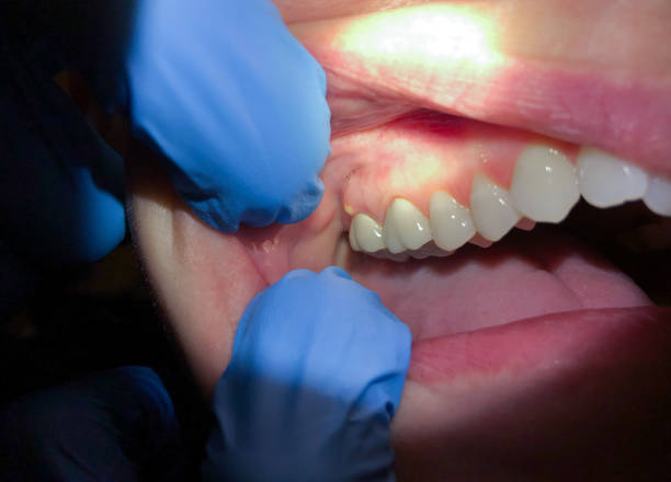 Best Emergency Tooth Extraction in Perryton, TX
